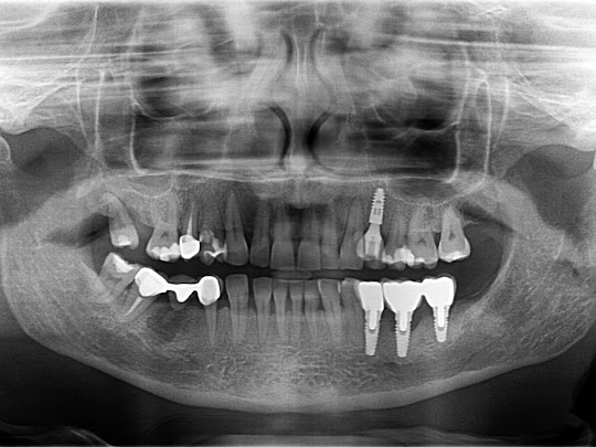 Zahnimplantat Röntgenaufnahme