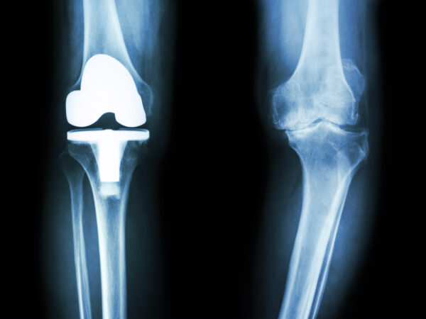 Behandlungsfehler bei Knieprothese